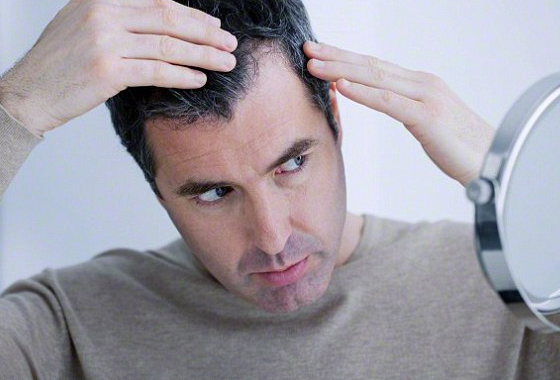 Respondemos 8 questões cruciais sobre calvície